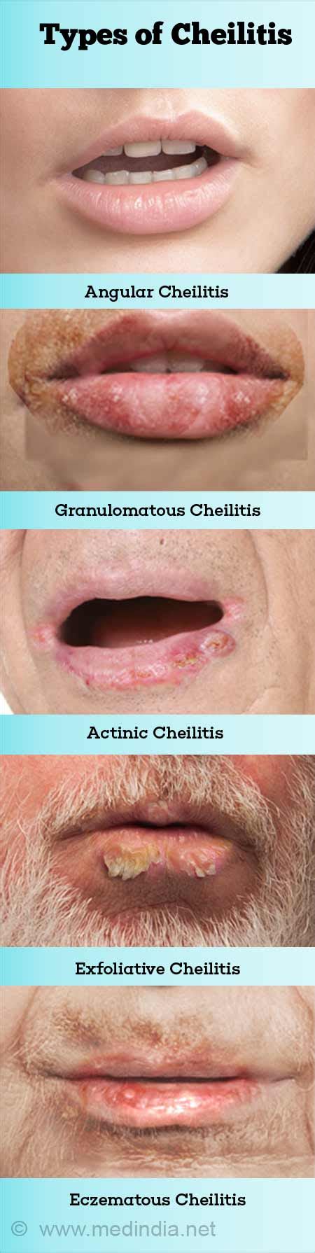 queilitis angular|Angular cheilitis: Treatment, causes, and contagiousness